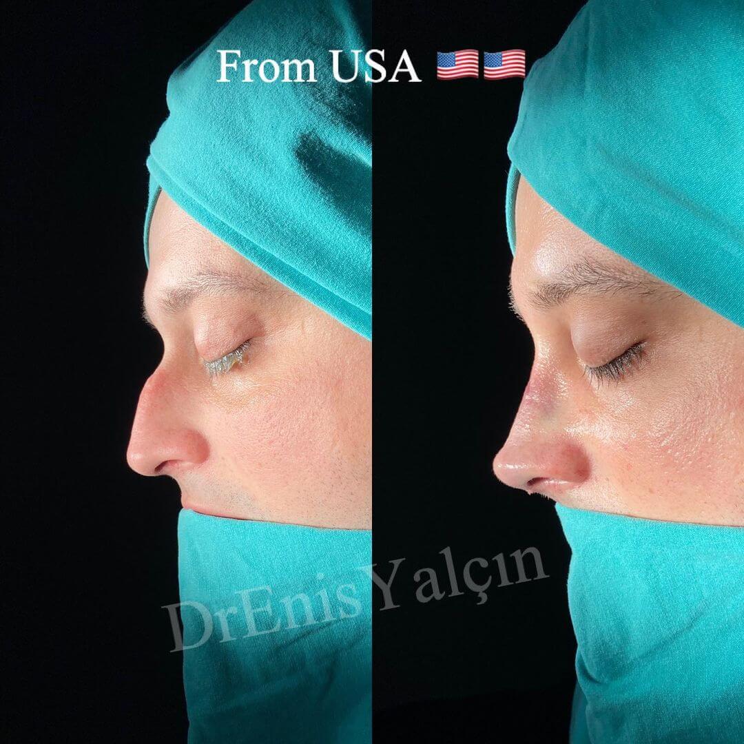 Male Rhinoplasty 1-3