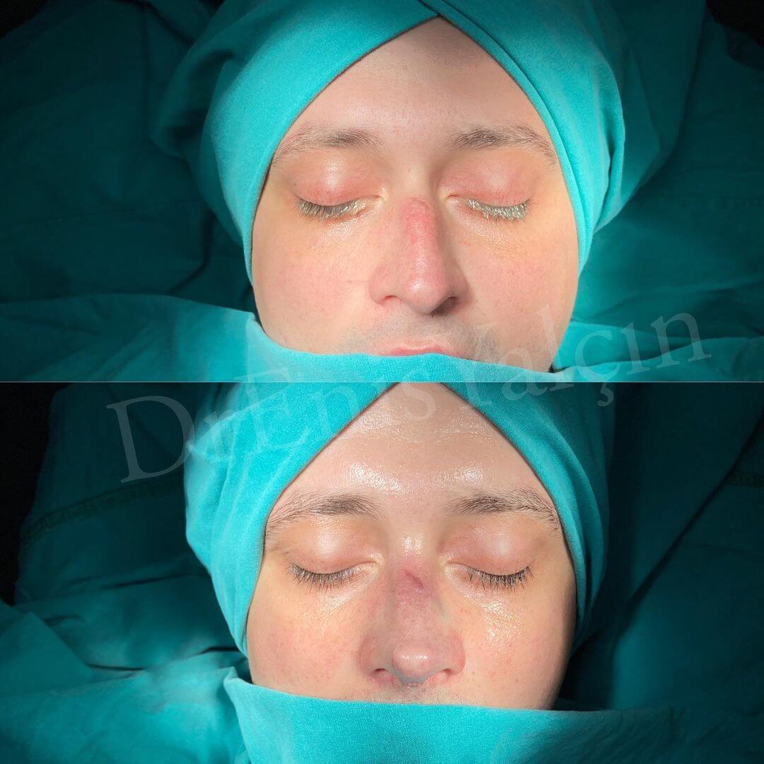 Male Rhinoplasty 1-4
