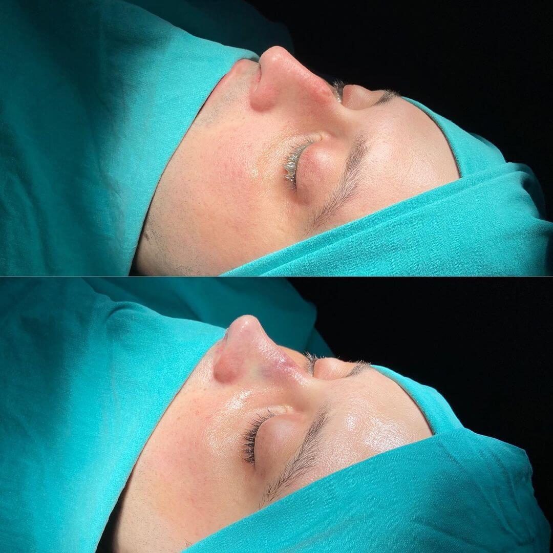 Male Rhinoplasty 1-5