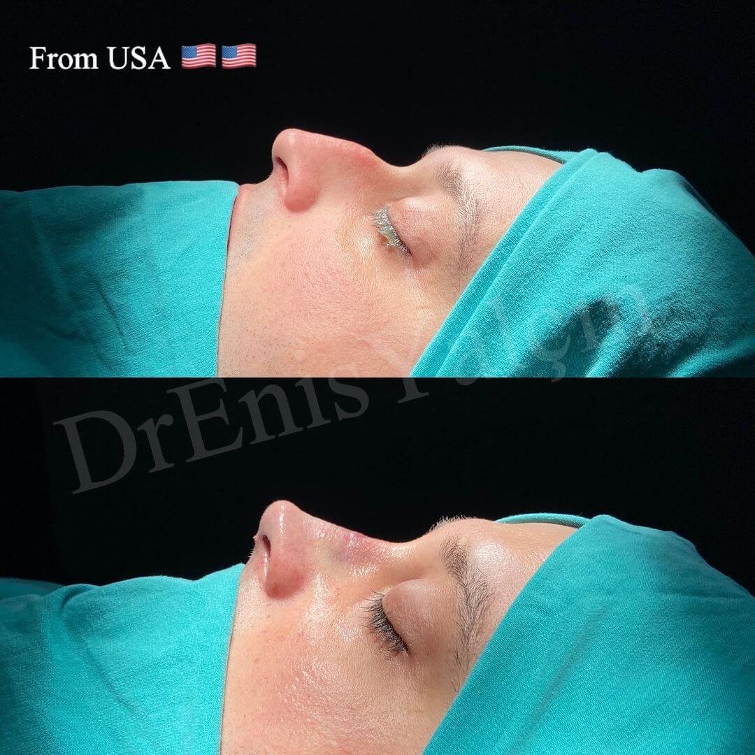 Male Rhinoplasty 1-6