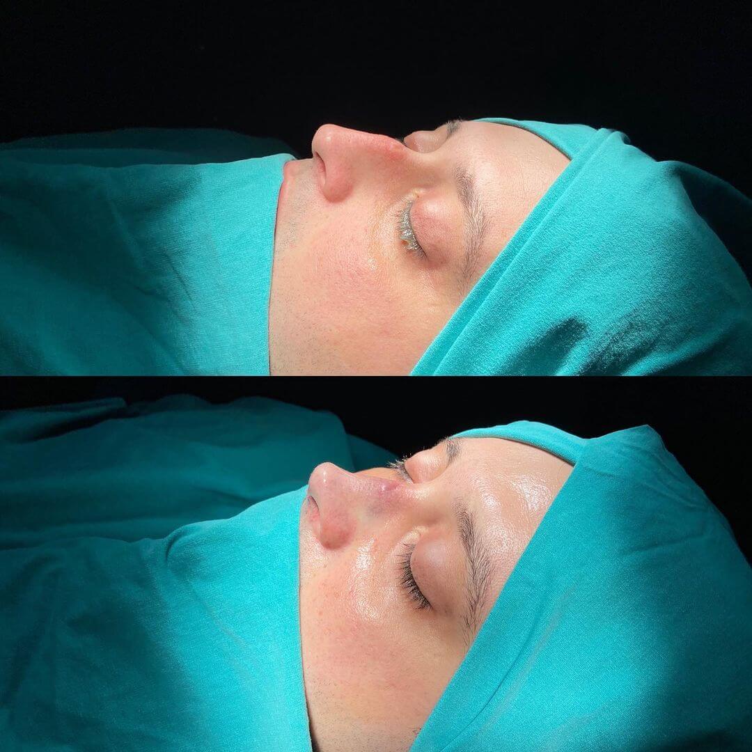 Male Rhinoplasty 1-7