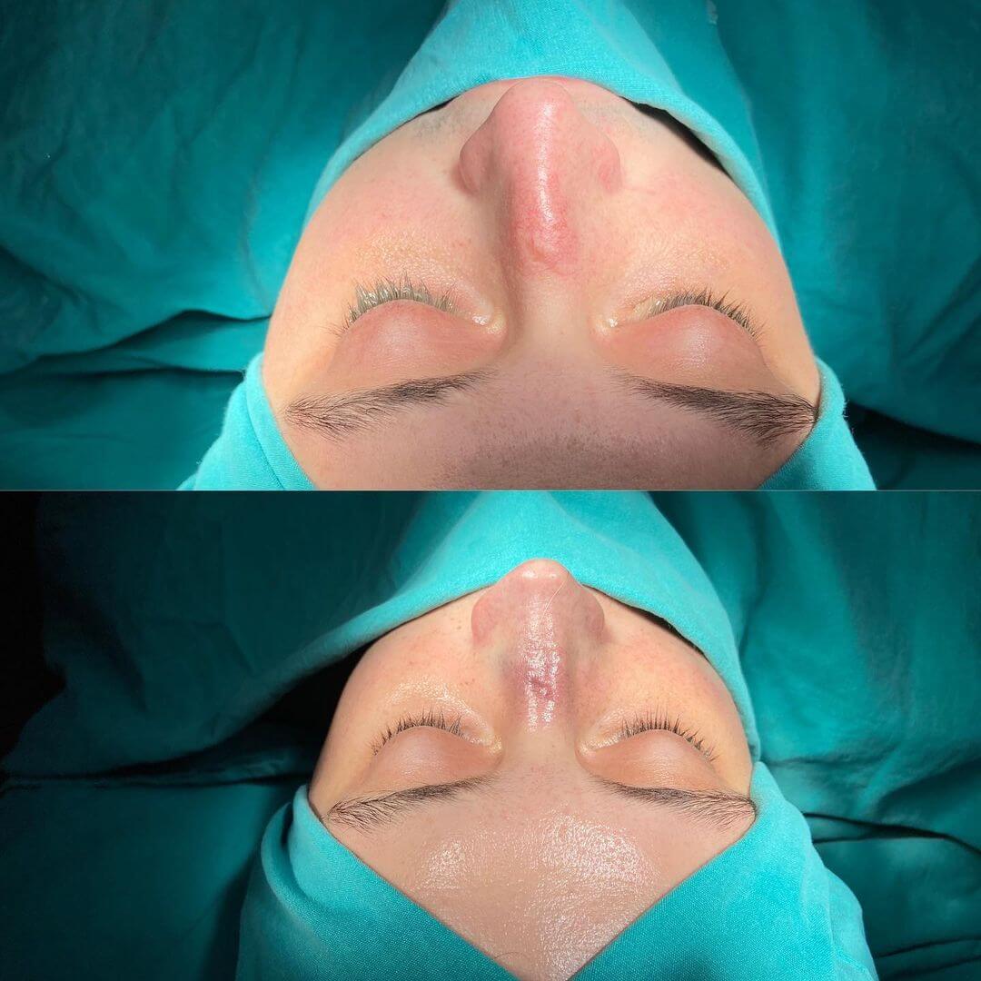 Male Rhinoplasty 1-8