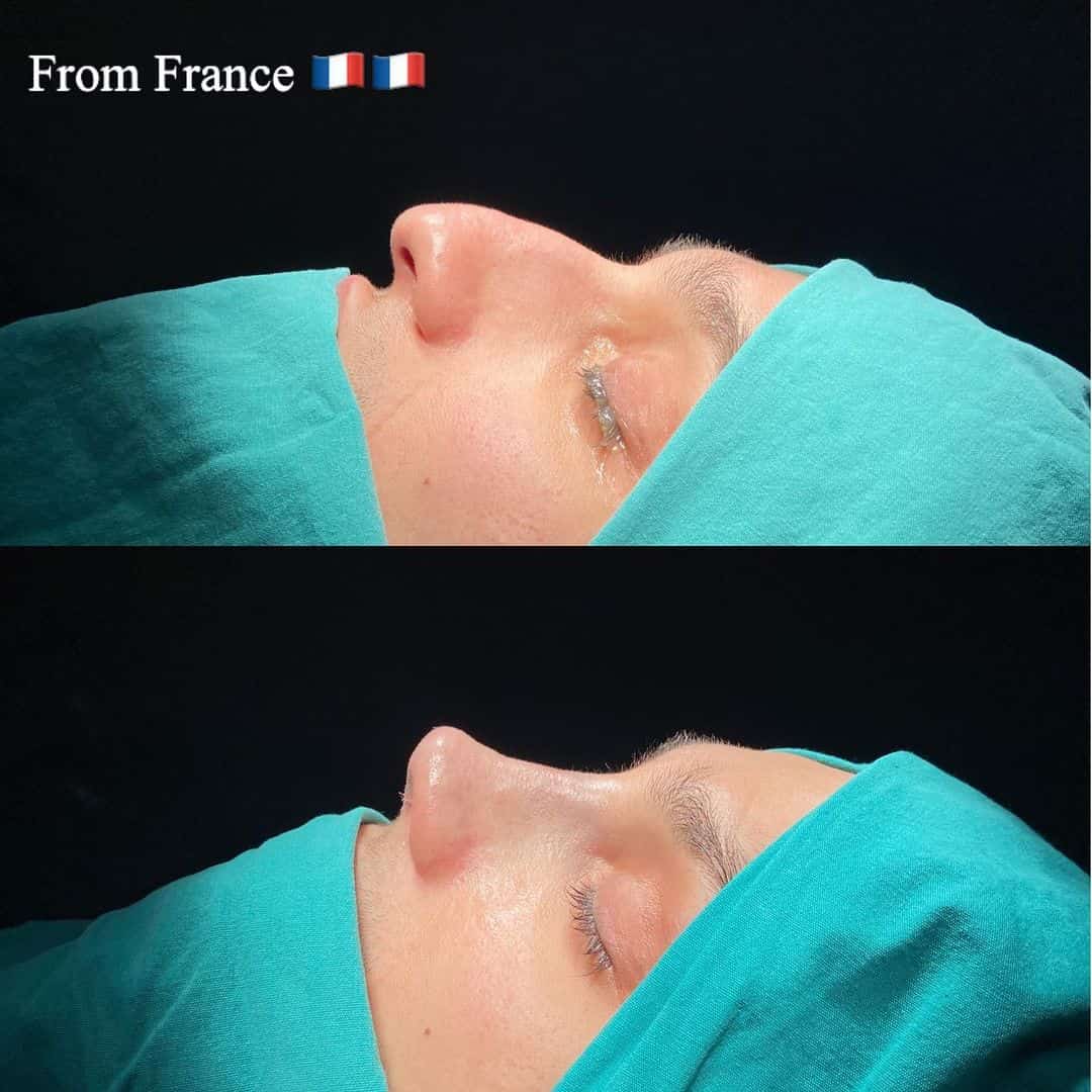 Male Rhinoplasty 2-1