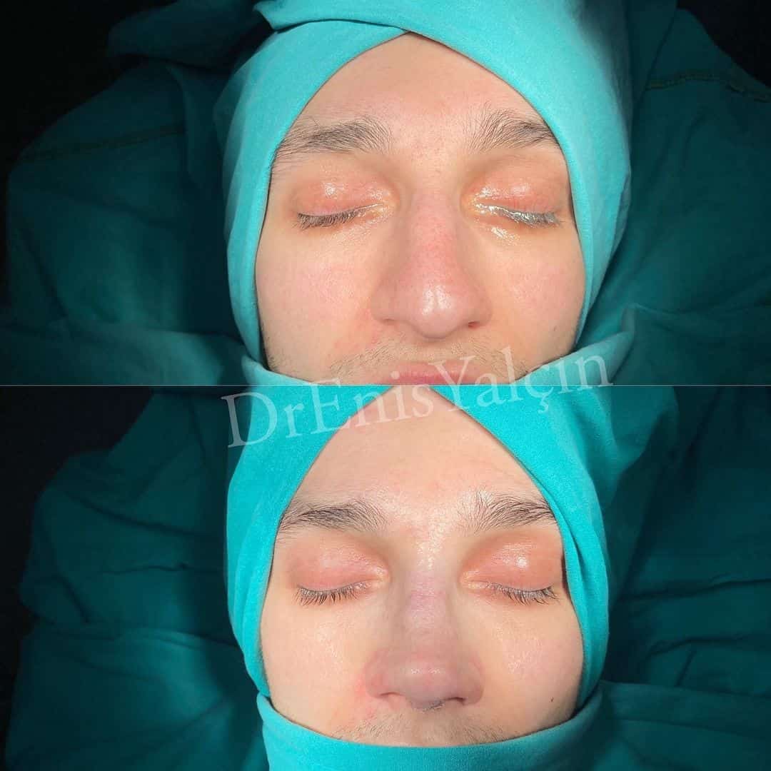 Male Rhinoplasty 2-2