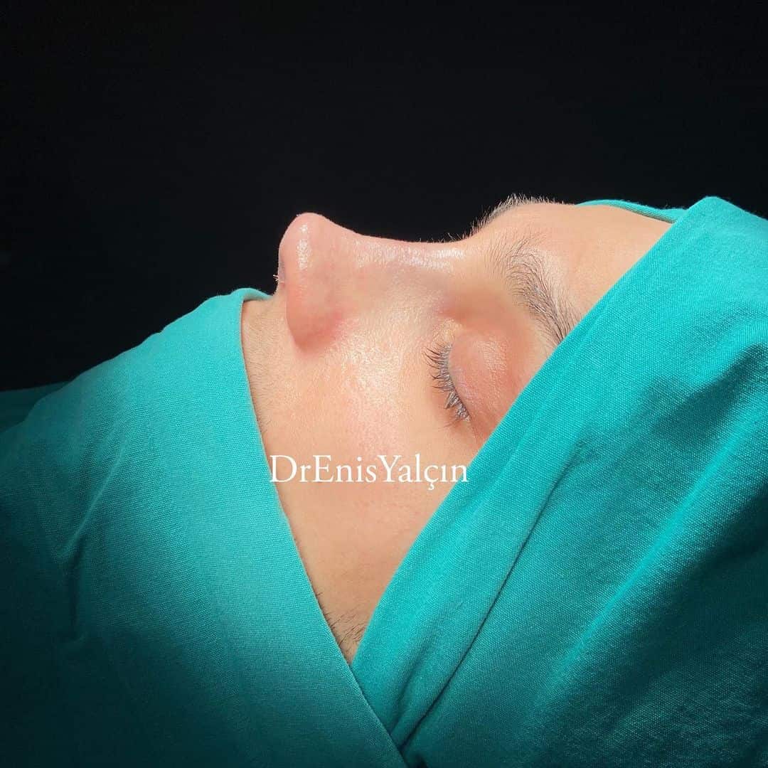Male Rhinoplasty 2-3