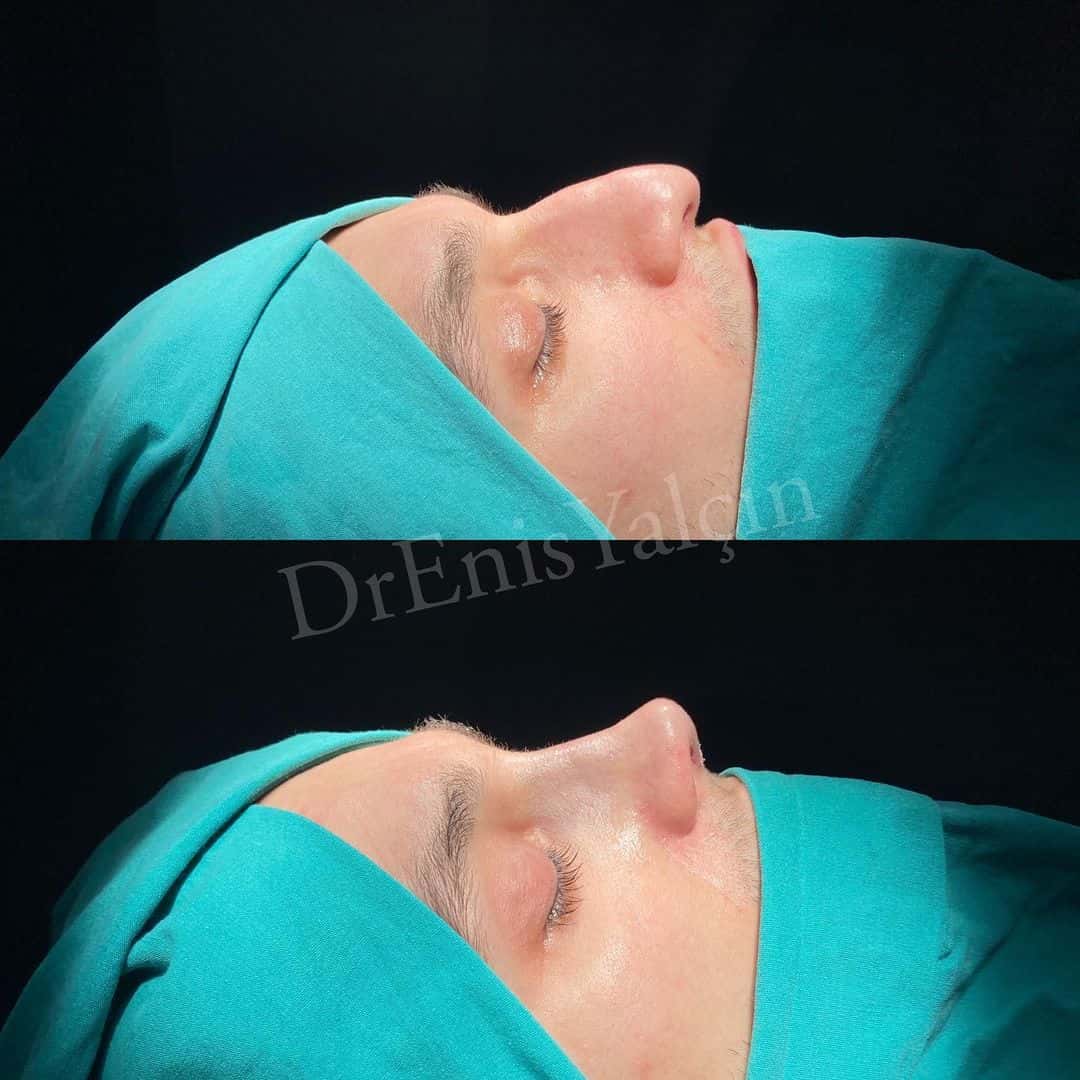 Male Rhinoplasty 2-4