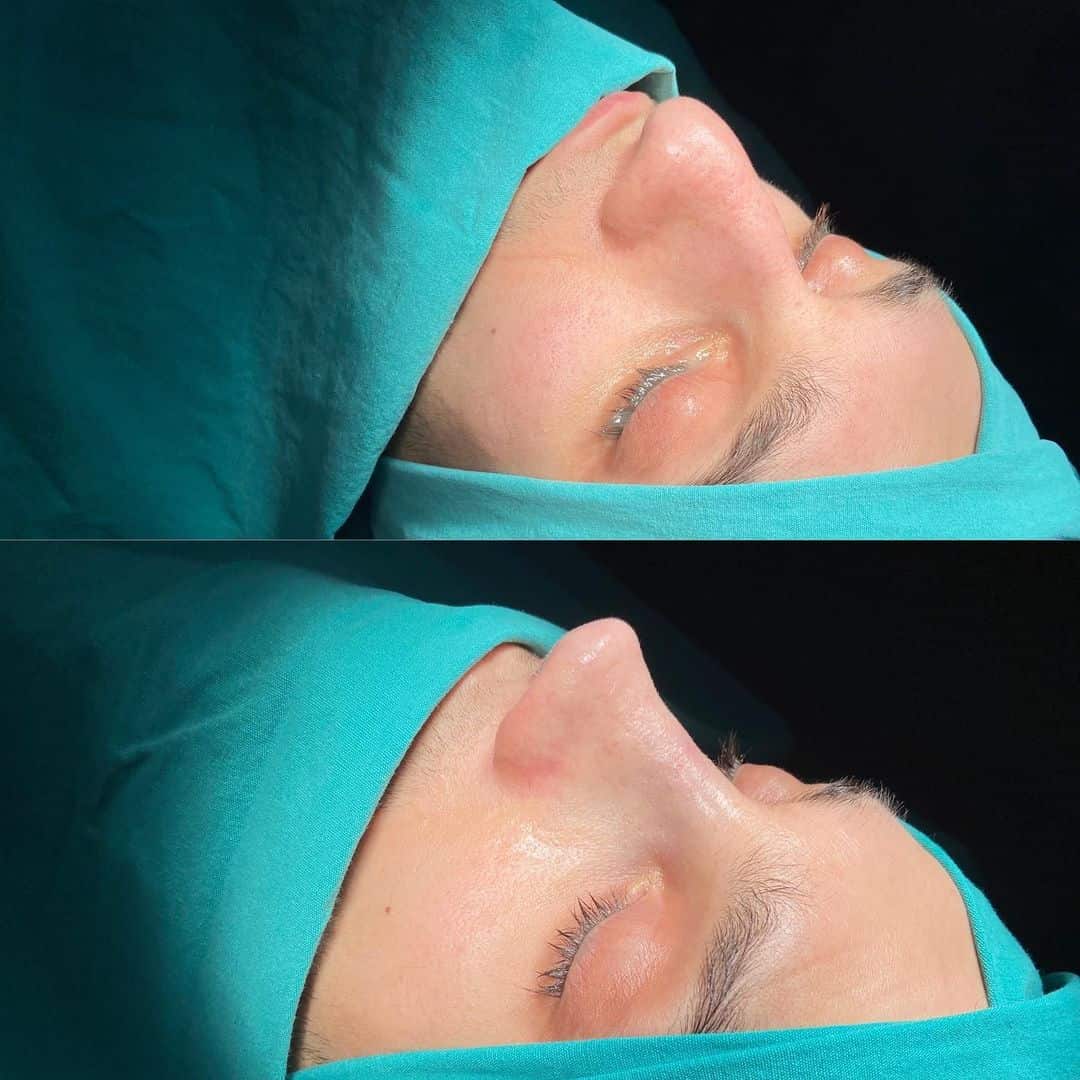 Male Rhinoplasty 2-5