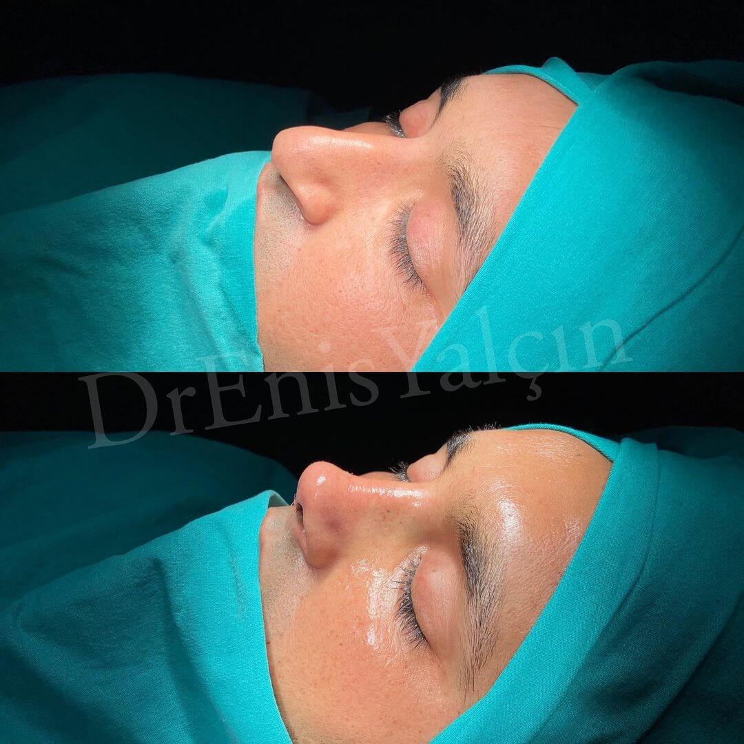Male Rhinoplasty 3-1
