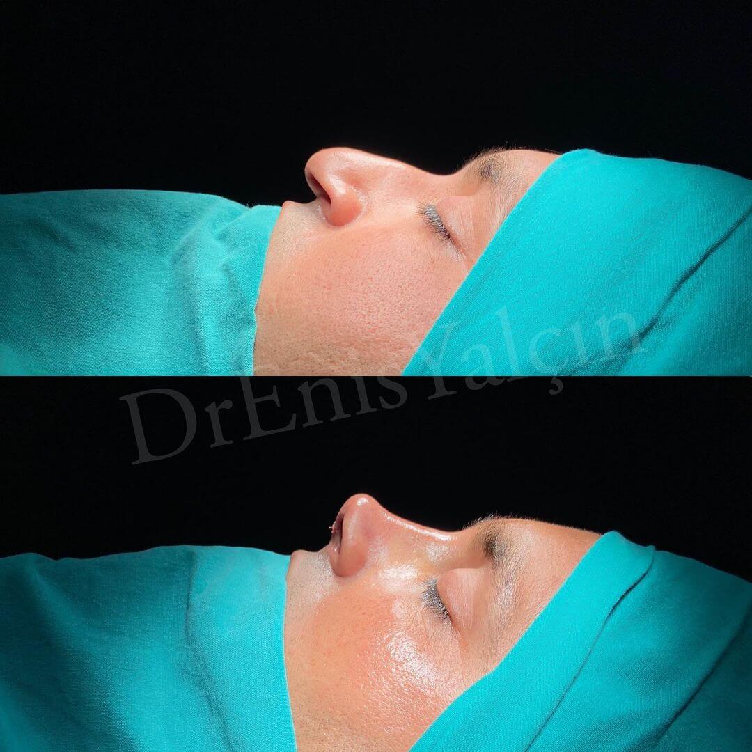Male Rhinoplasty 3-2