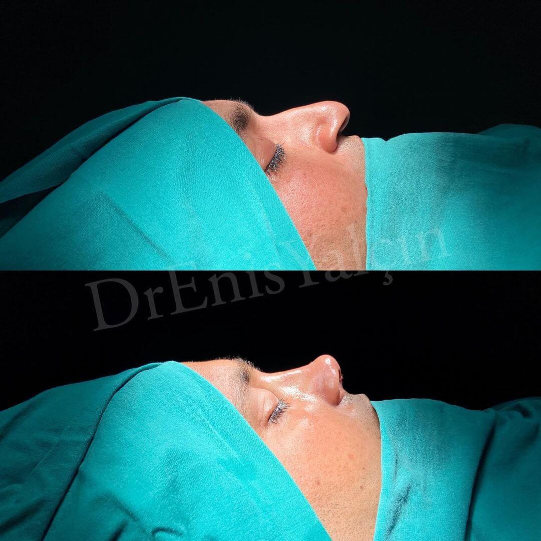 Male Rhinoplasty 3-3