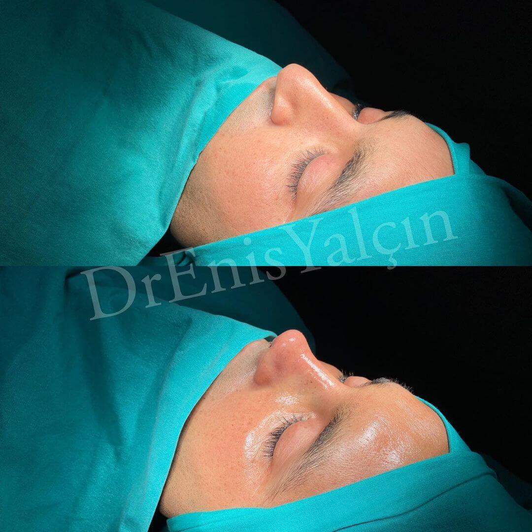Male Rhinoplasty 3-4