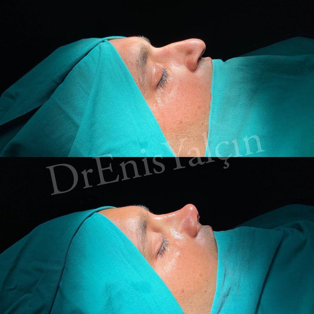 Male Rhinoplasty 3-5