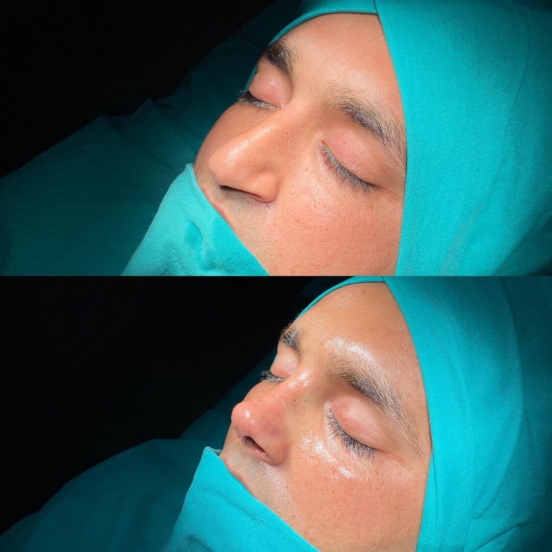 Male Rhinoplasty 3-6