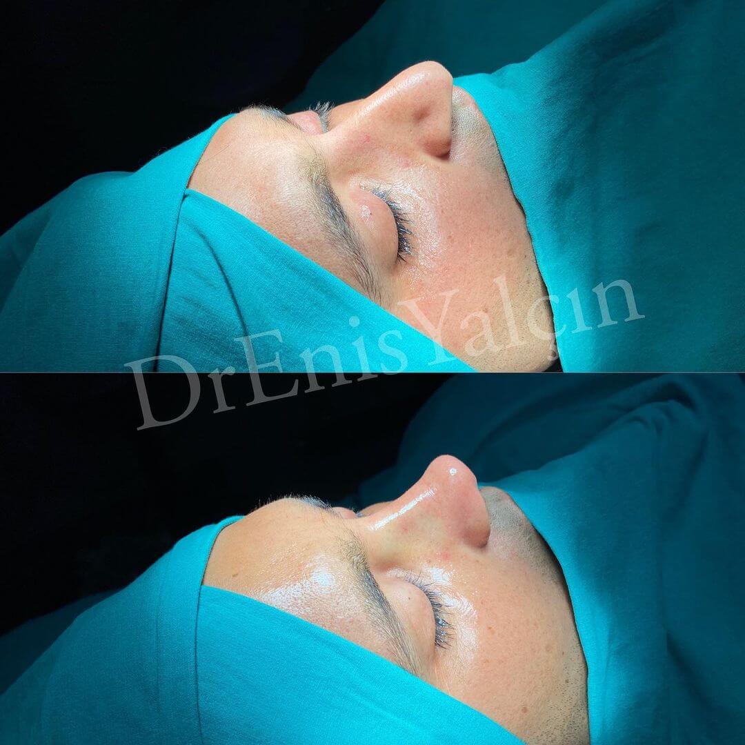 Male Rhinoplasty 3-7