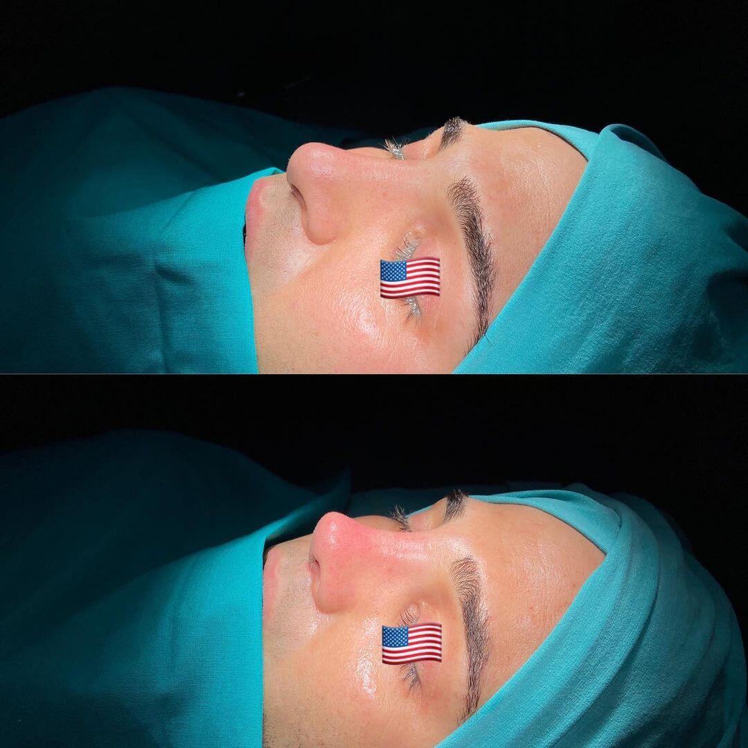 Male Rhinoplasty 4-1