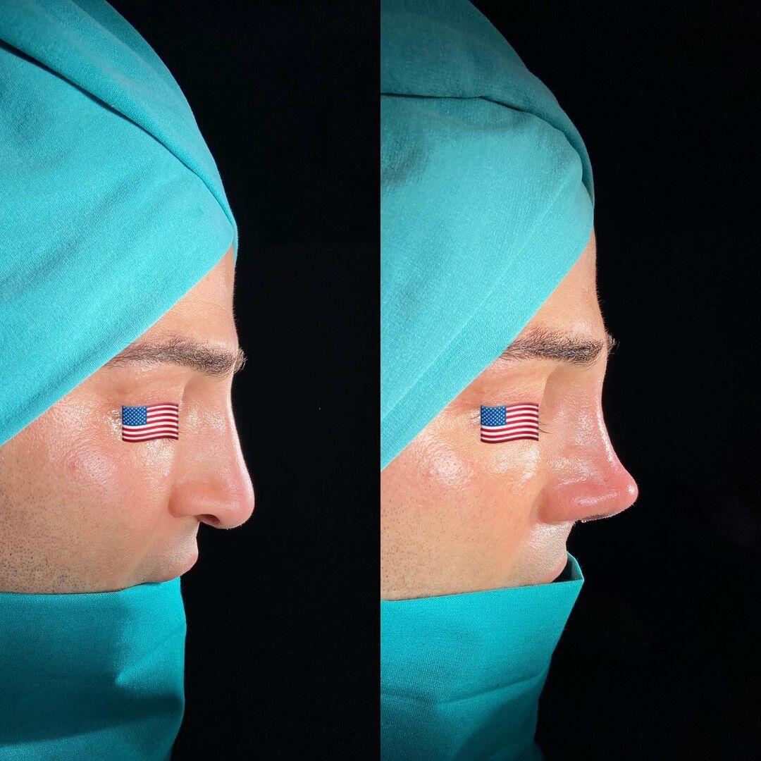 Male Rhinoplasty 4-2