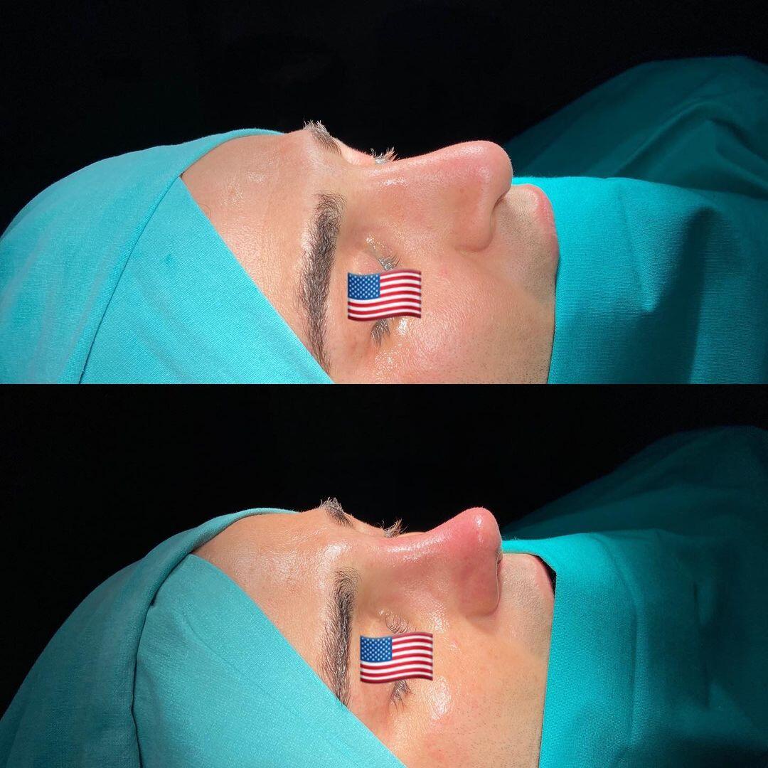 Male Rhinoplasty 4-3