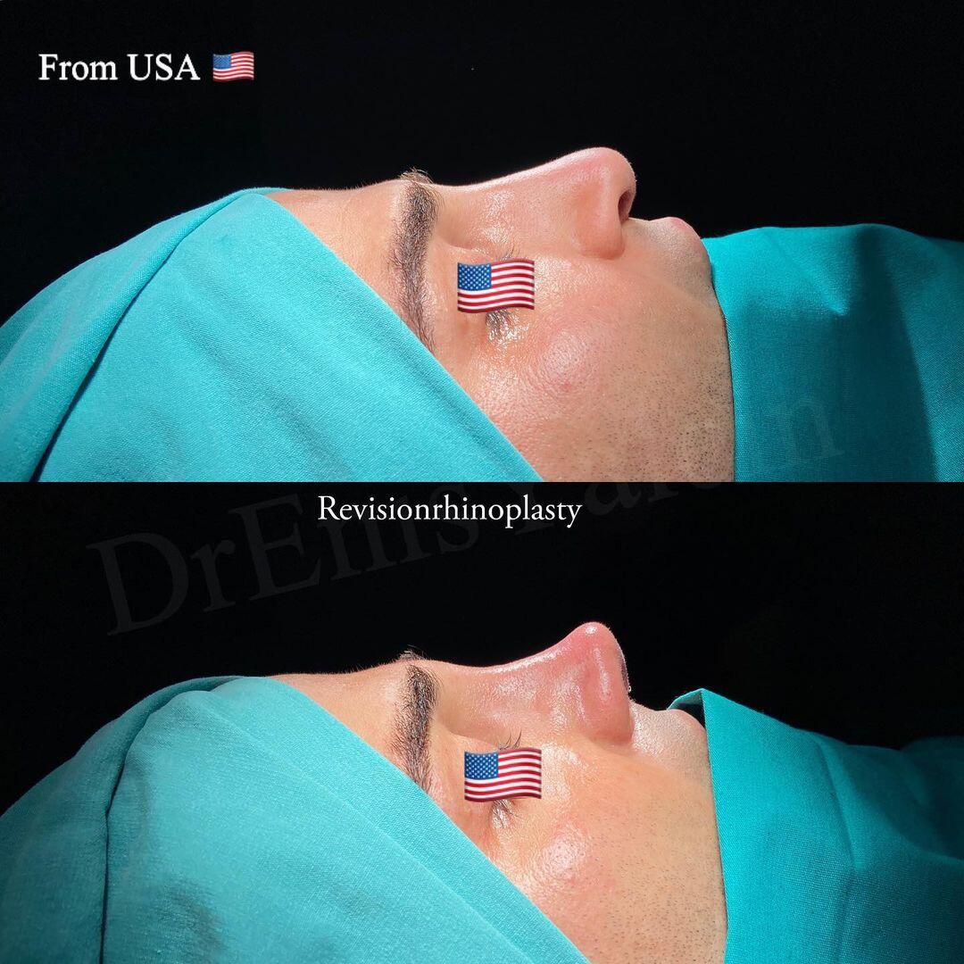 Male Rhinoplasty 4-4