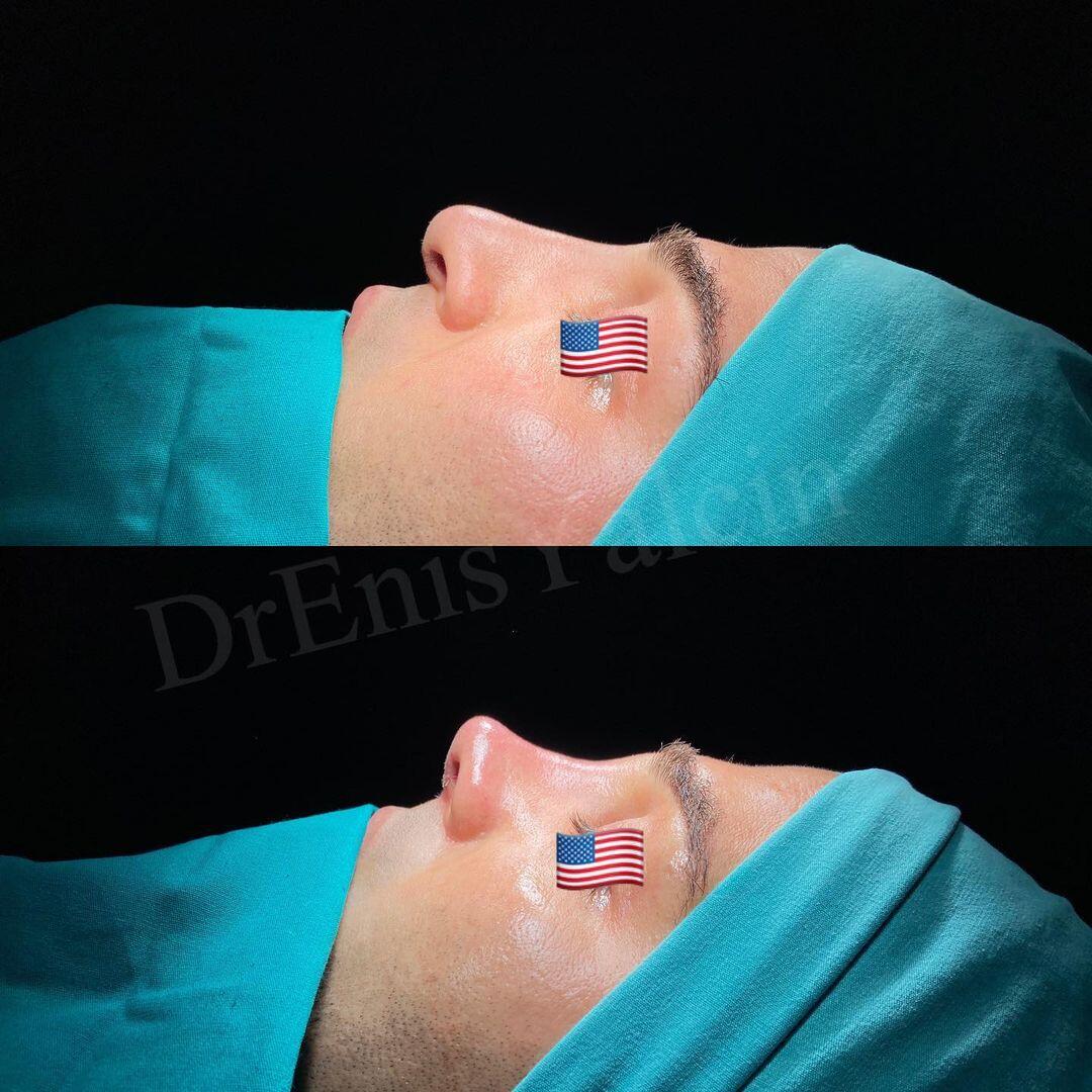 Male Rhinoplasty 4-5