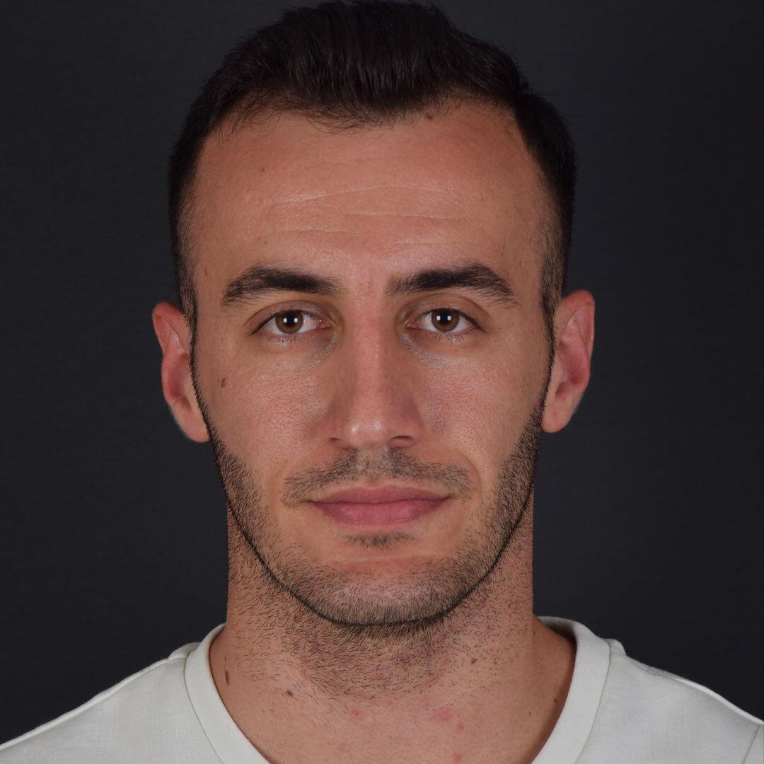 Male Rhinoplasty 5-1