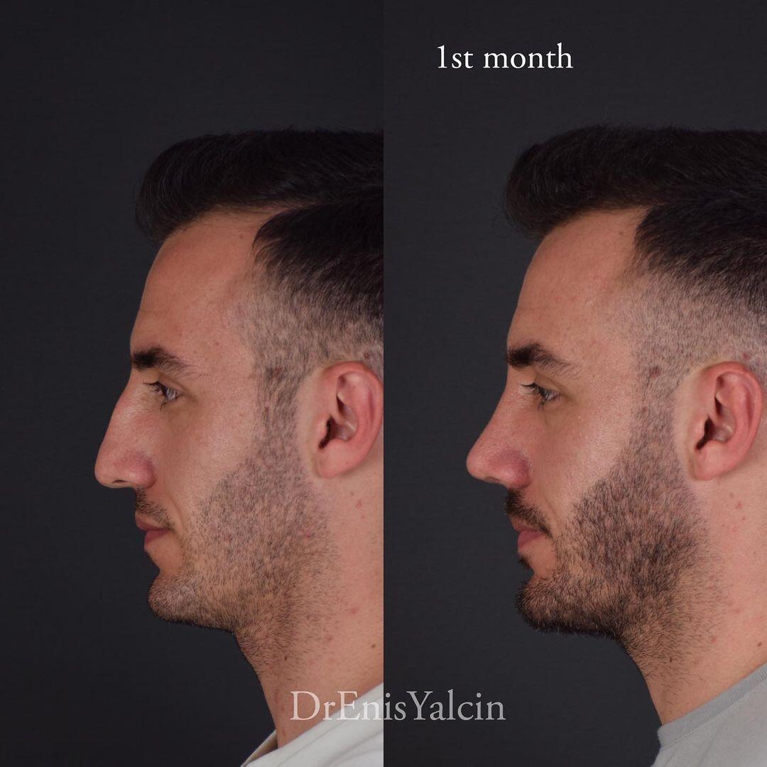 Male Rhinoplasty 5-3