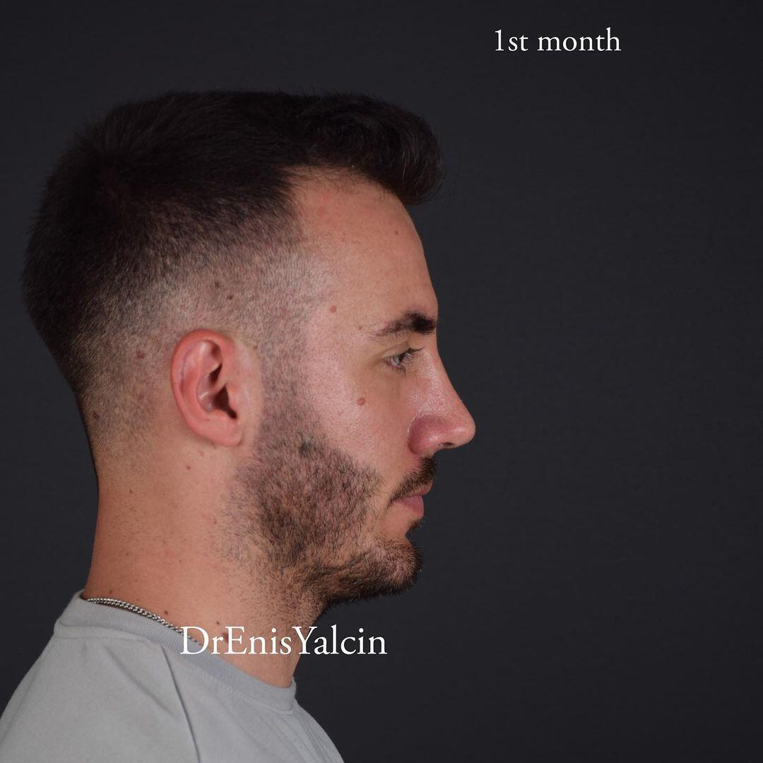 Male Rhinoplasty 5-5