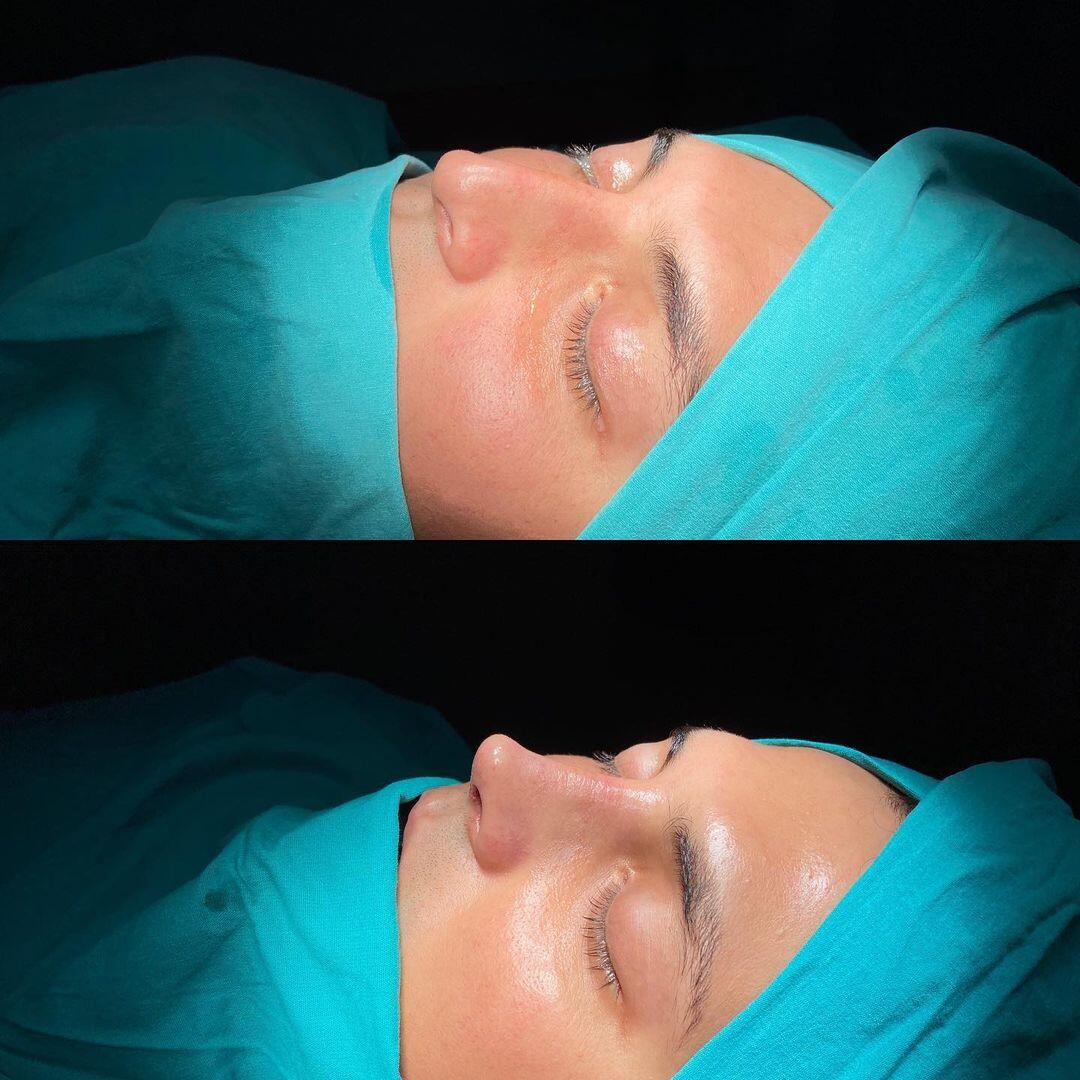 Male Rhinoplasty 6-1