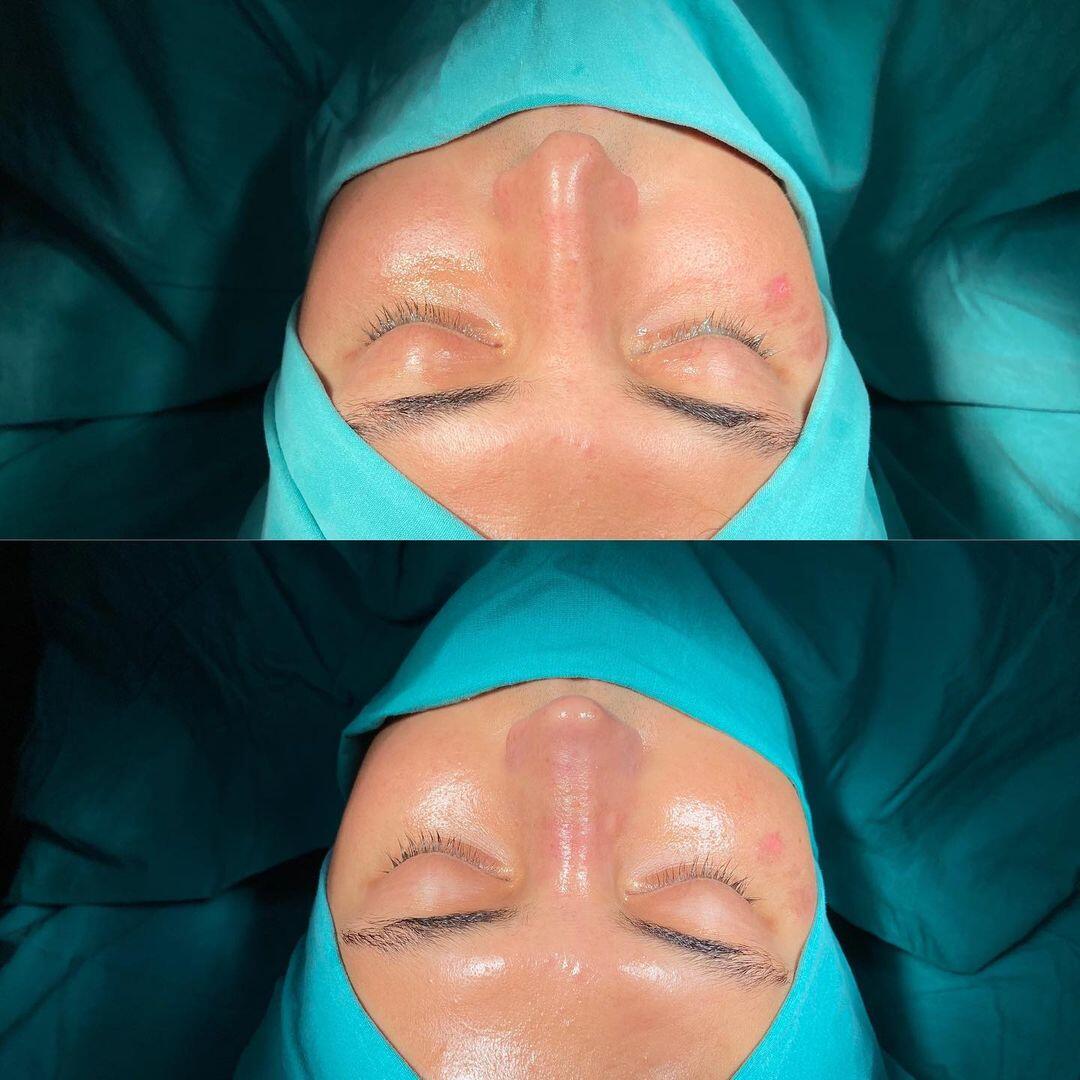Male Rhinoplasty 6-2
