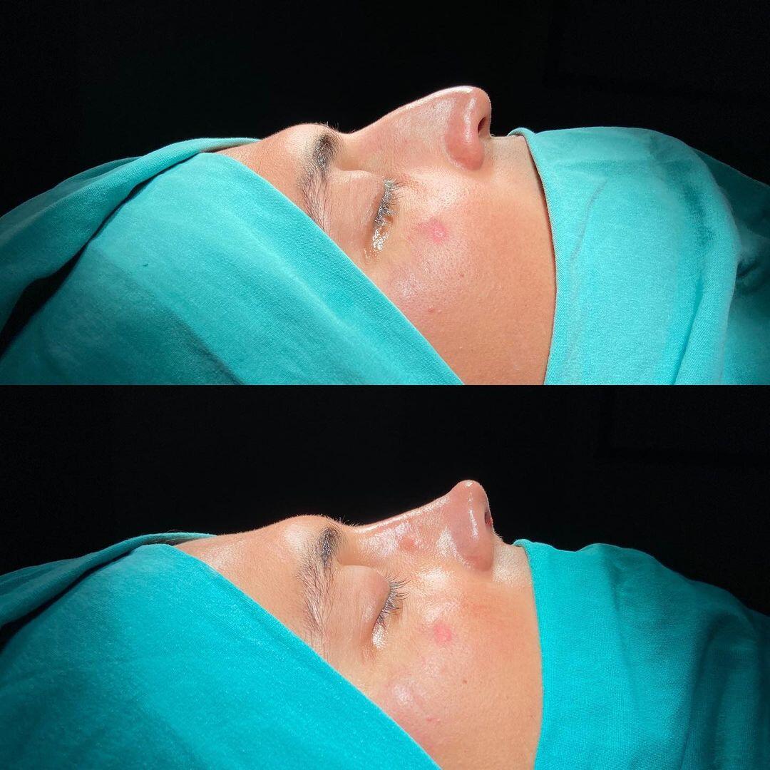 Male Rhinoplasty 6-3