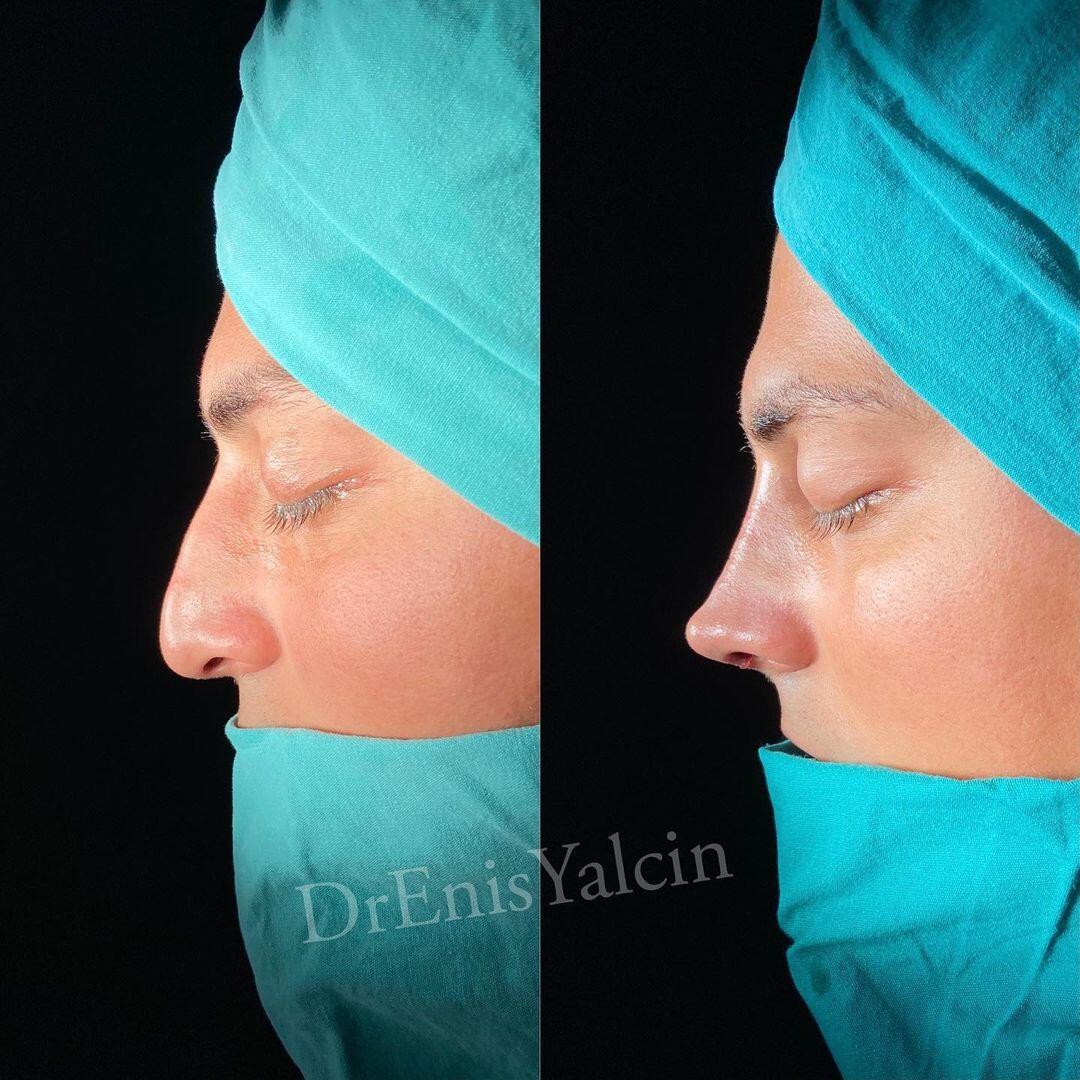 Male Rhinoplasty 6-4