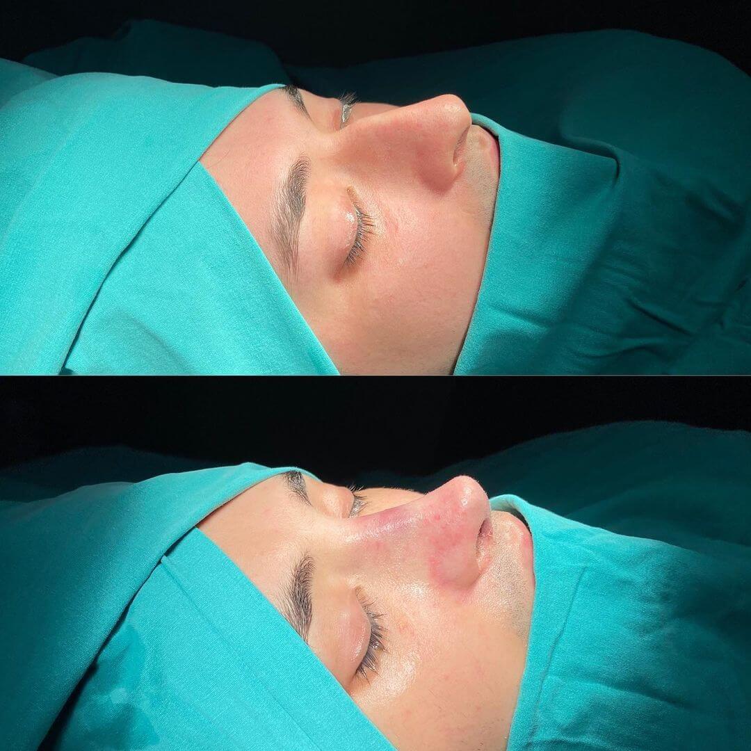 Male Rhinoplasty 7-1