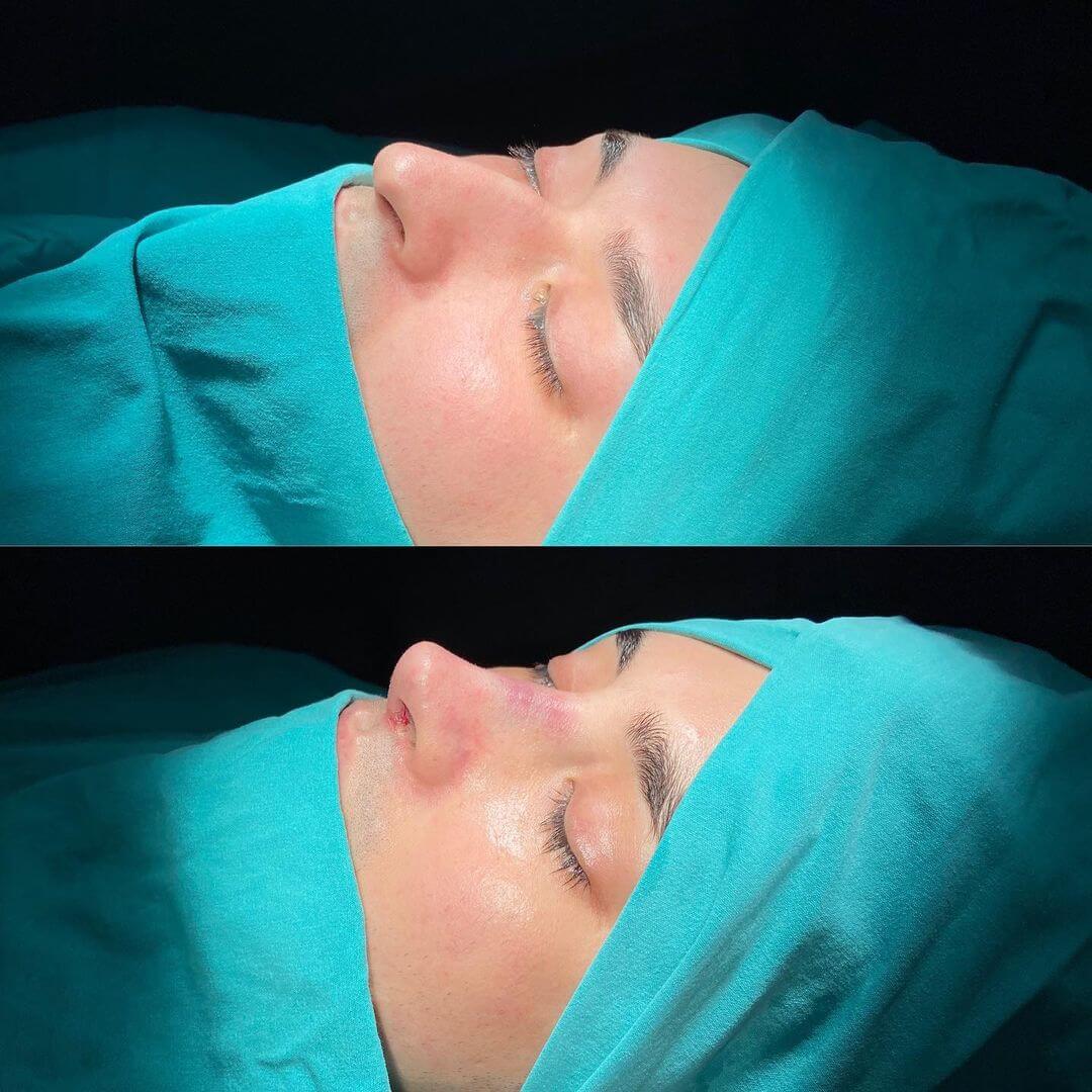 Male Rhinoplasty 7-2