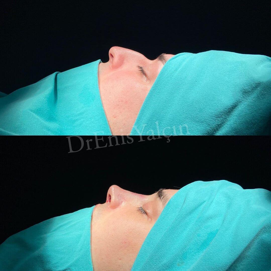 Male Rhinoplasty 7-3