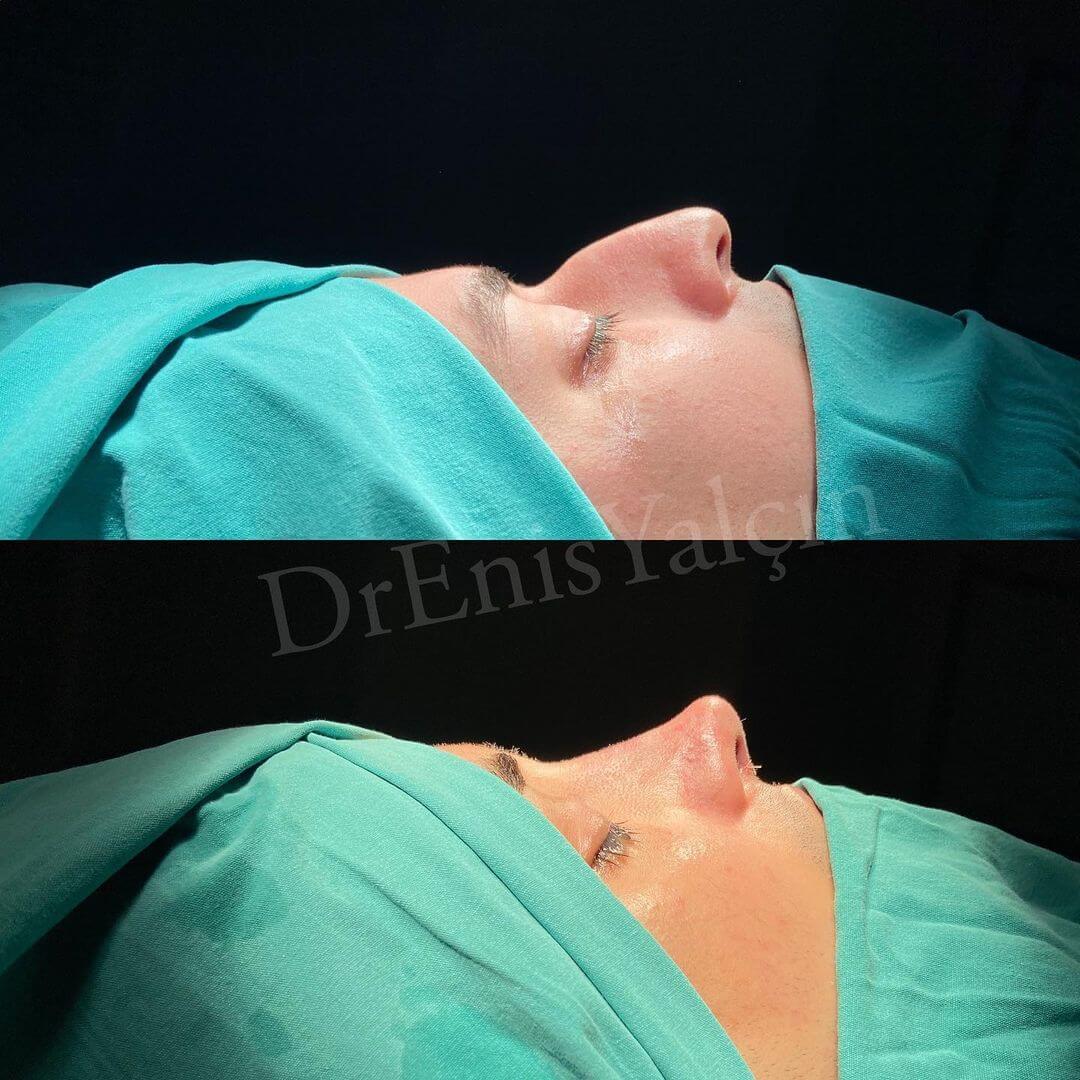 Male Rhinoplasty 7-4