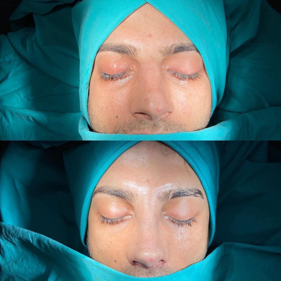 Male Rhinoplasty 8-1