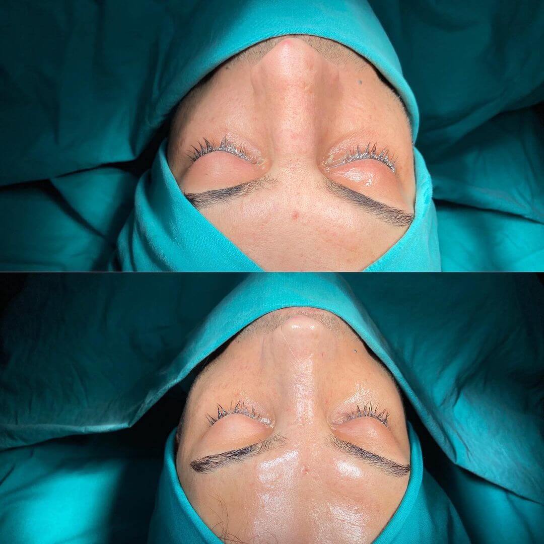 Male Rhinoplasty 8-2