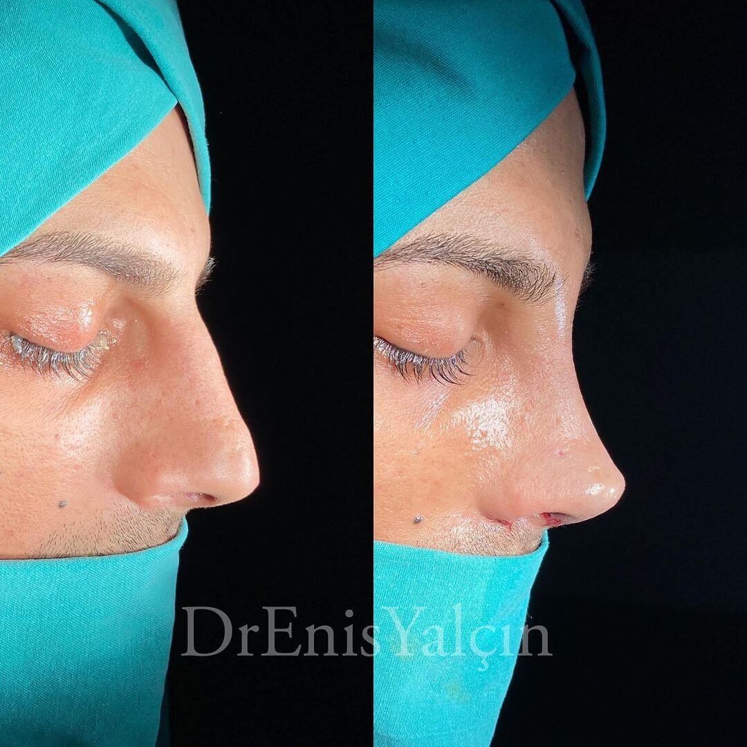 Male Rhinoplasty 8-3