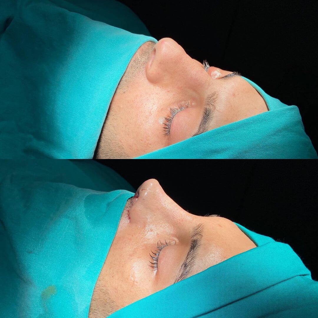 Male Rhinoplasty 8-4