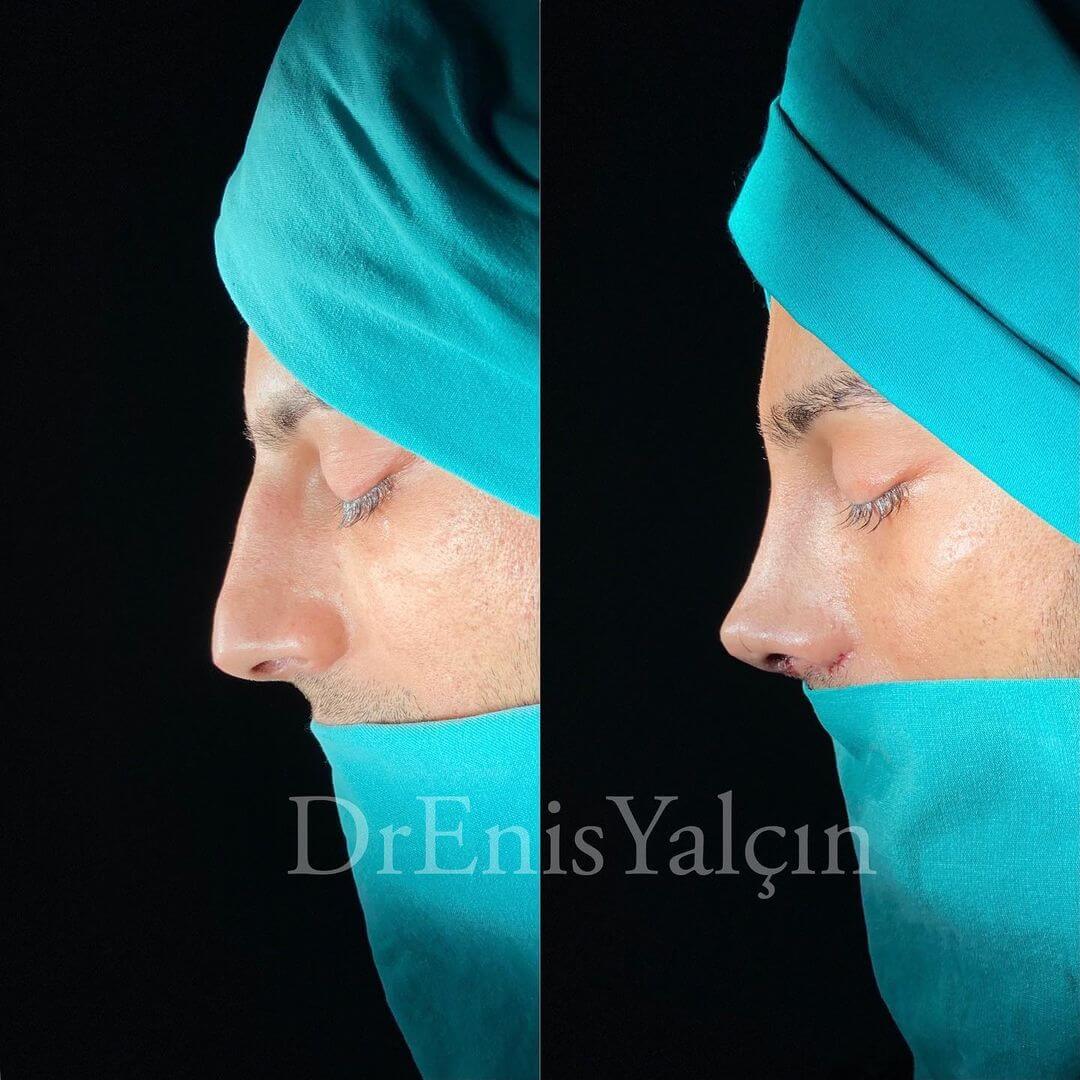Male Rhinoplasty 8-5
