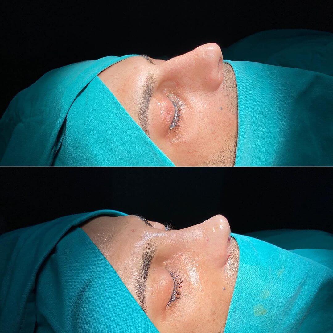Male Rhinoplasty 8-6