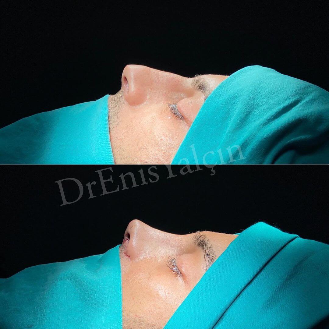 Male Rhinoplasty 8-7