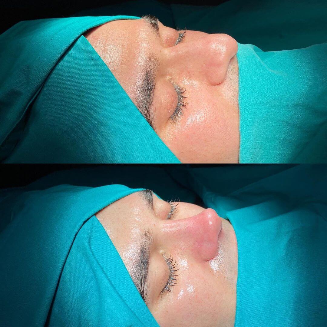 Male Rhinoplasty 9-1
