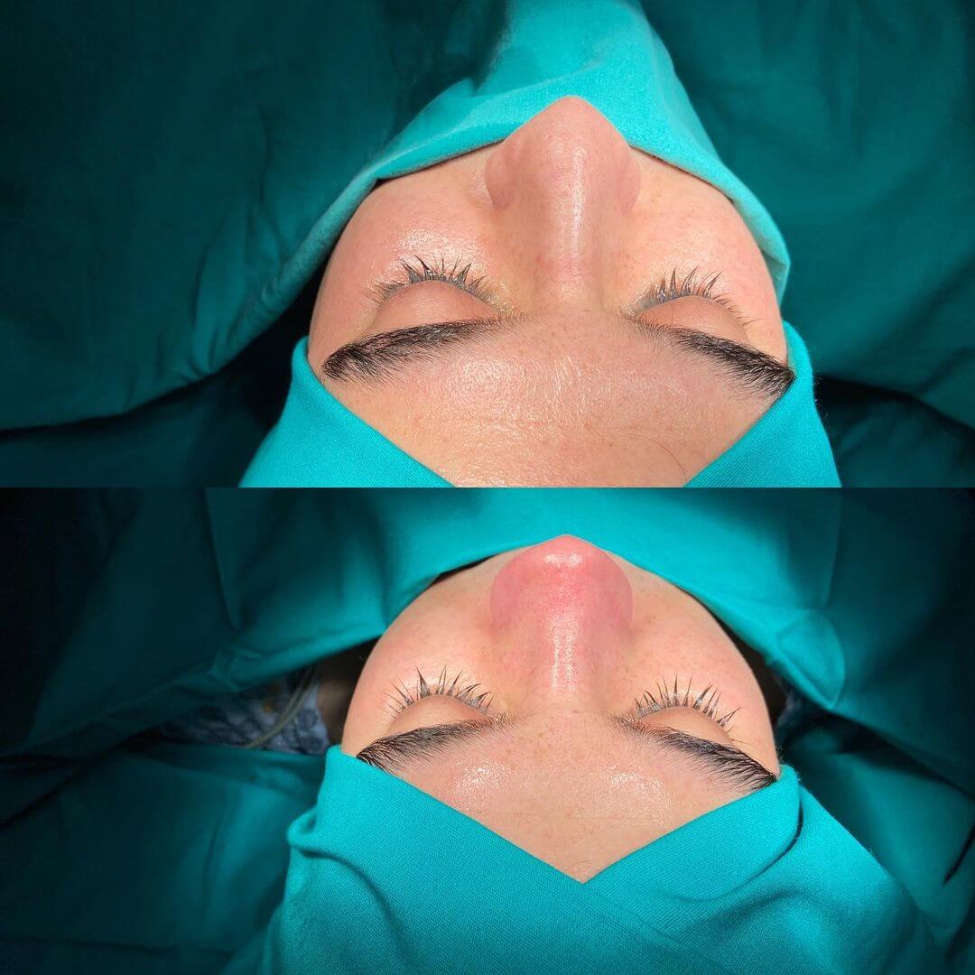 Male Rhinoplasty 9-2