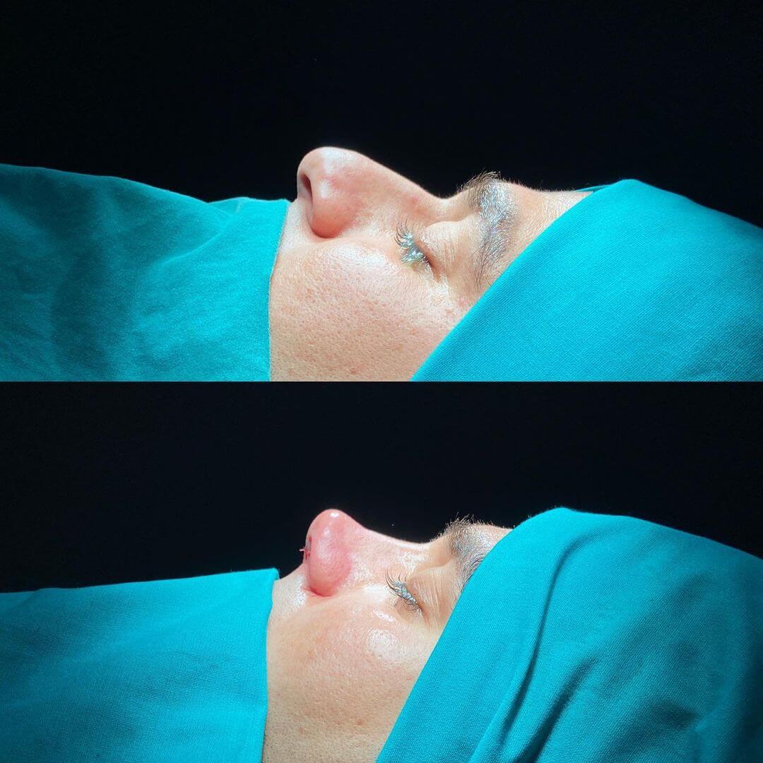 Male Rhinoplasty 9-3