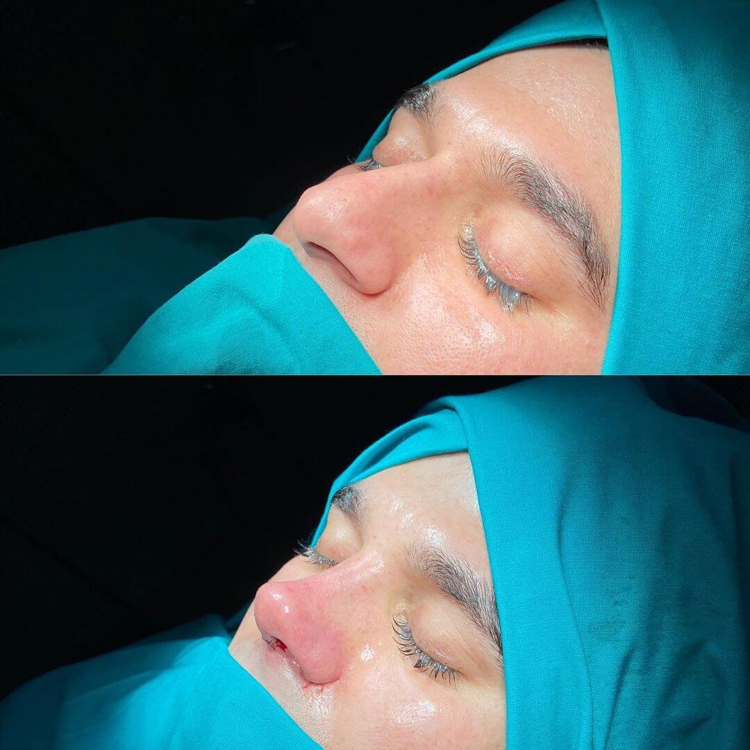 Male Rhinoplasty 9-4
