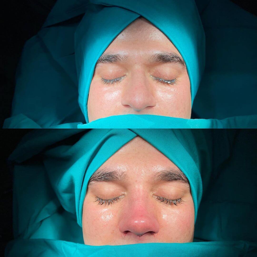 Male Rhinoplasty 9-5