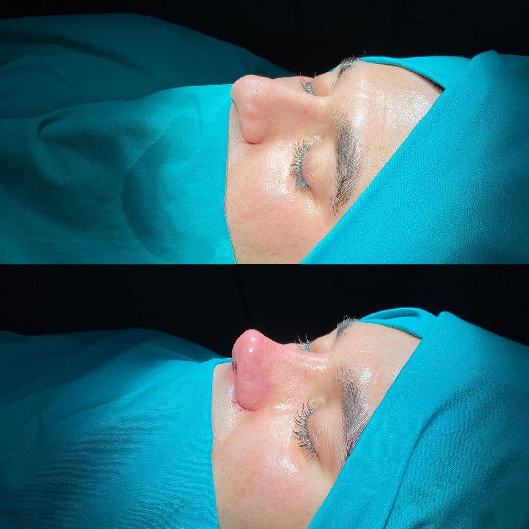 Male Rhinoplasty 9-6