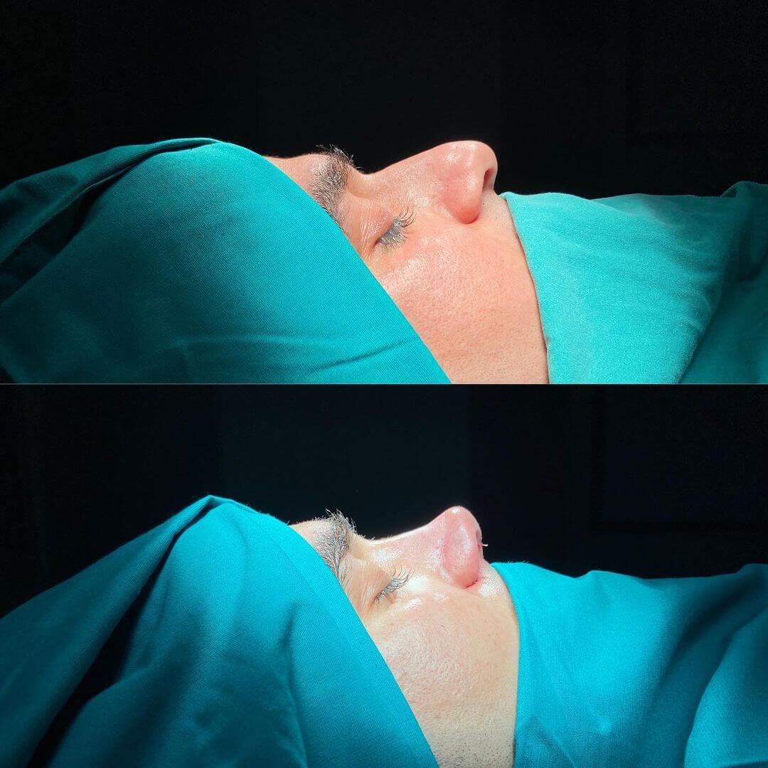 Male Rhinoplasty 9-7