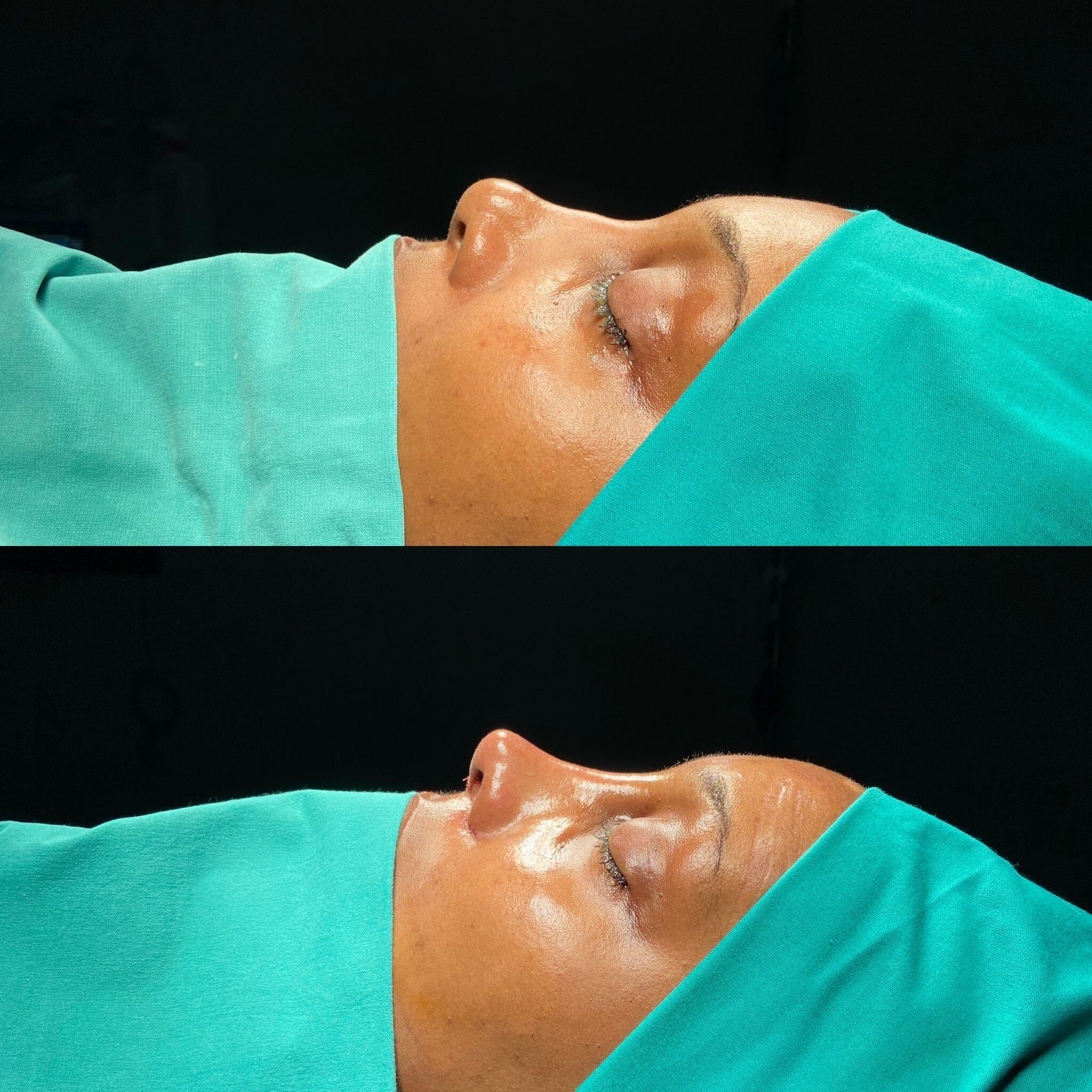 Revision Rhinoplasty 1-1