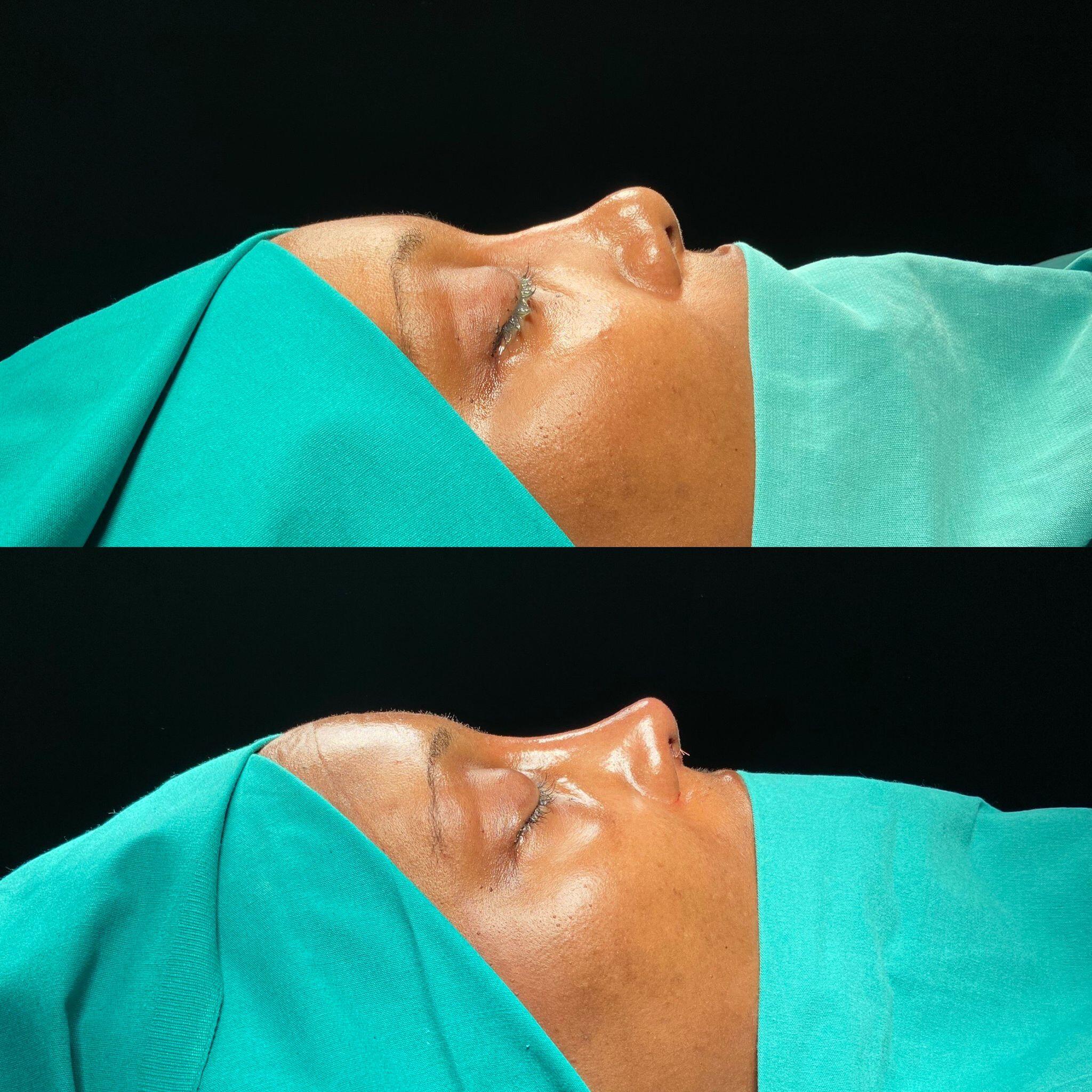 Revision Rhinoplasty 1-2